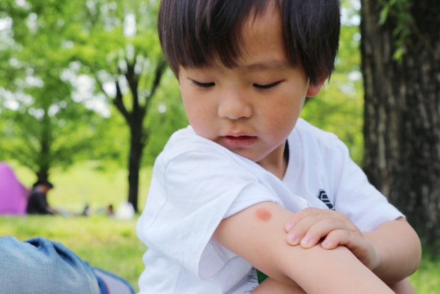 虫刺されが気になる子供